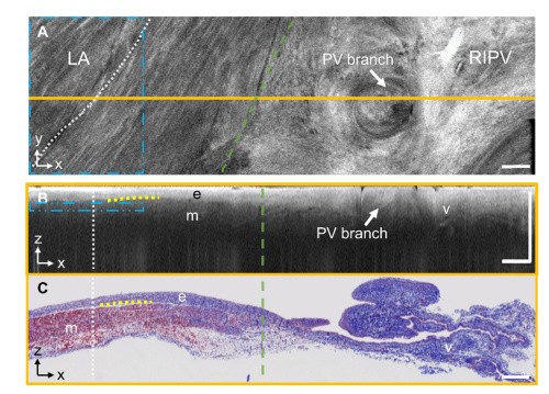 Mapping the human pulmonary venoatrial junction with optical coherence tomography