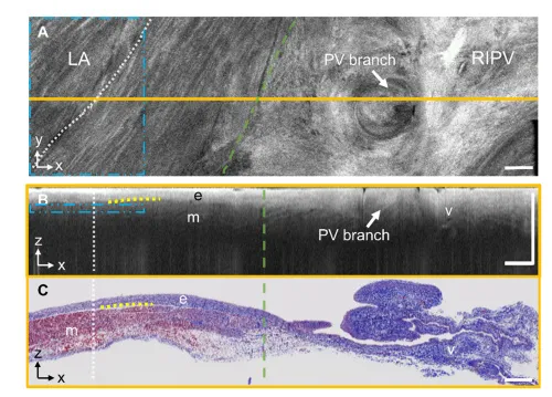 Mapping the human pulmonary venoatrial junction with optical coherence tomography